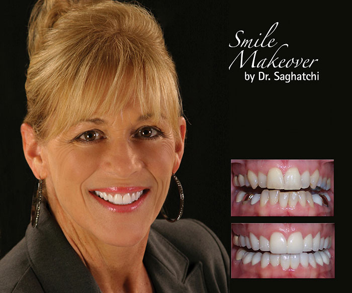 Smile Makeover by Dr. Saghatchi-10