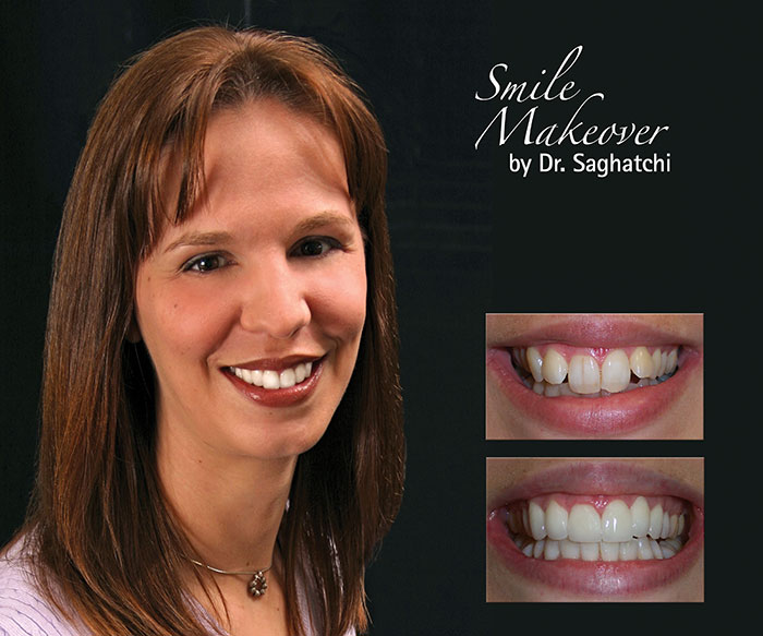 Smile Makeover by Dr. Saghatchi-5