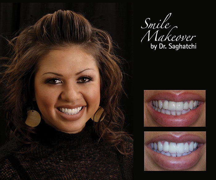 Smile Makeover by Dr. Saghatchi-4