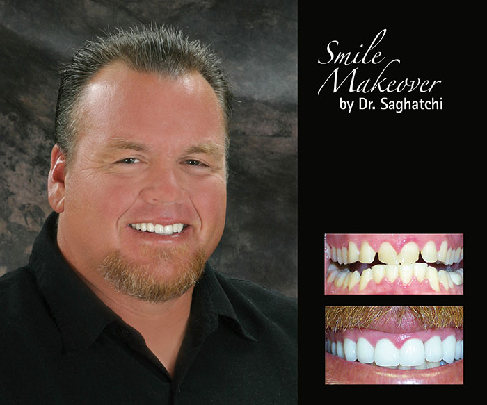 Smile Makeover by Dr. Saghatchi-14