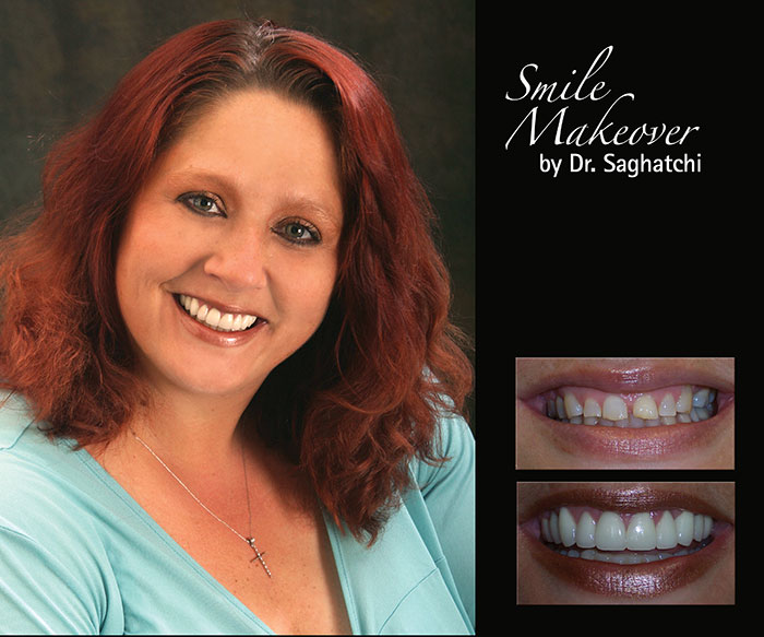 Smile Makeover by Dr. Saghatchi-13