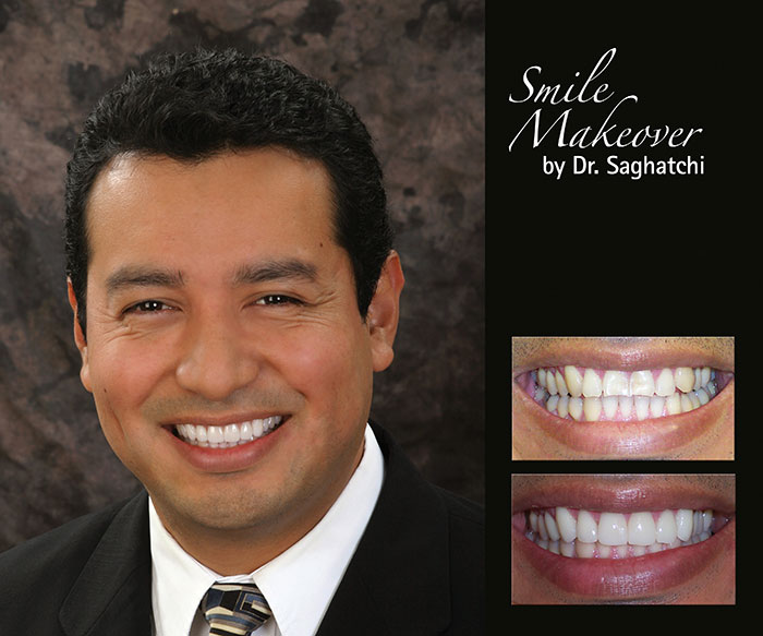 Smile Makeover by Dr. Saghatchi-15
