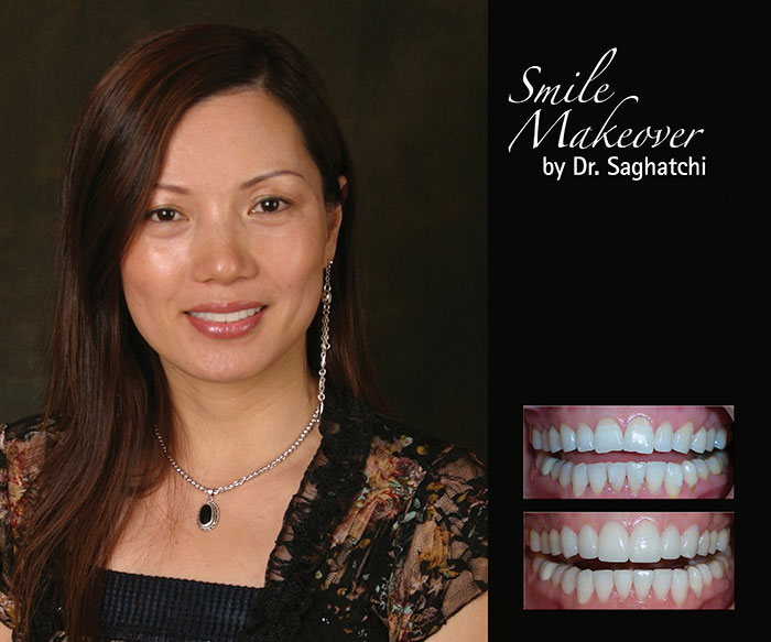 Smile Makeover by Dr. Saghatchi-18