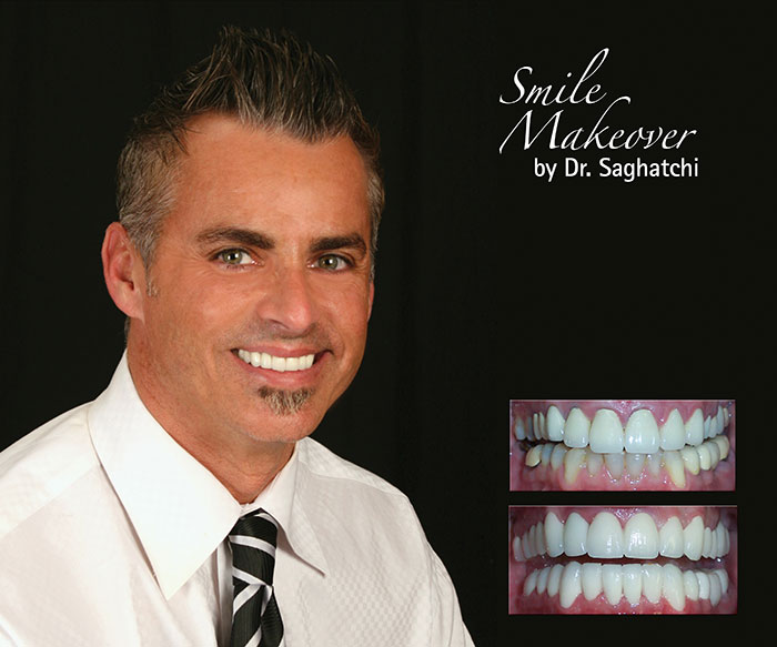 Smile Makeover by Dr. Saghatchi-12