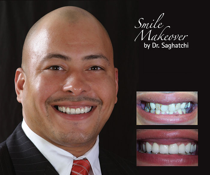 Smile Makeover by Dr. Saghatchi-2