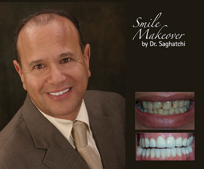 Smile Makeover by Dr. Saghatchi-17