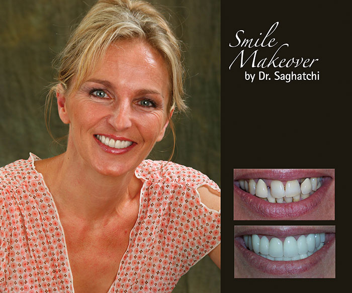 Smile Makeover by Dr. Saghatchi-3