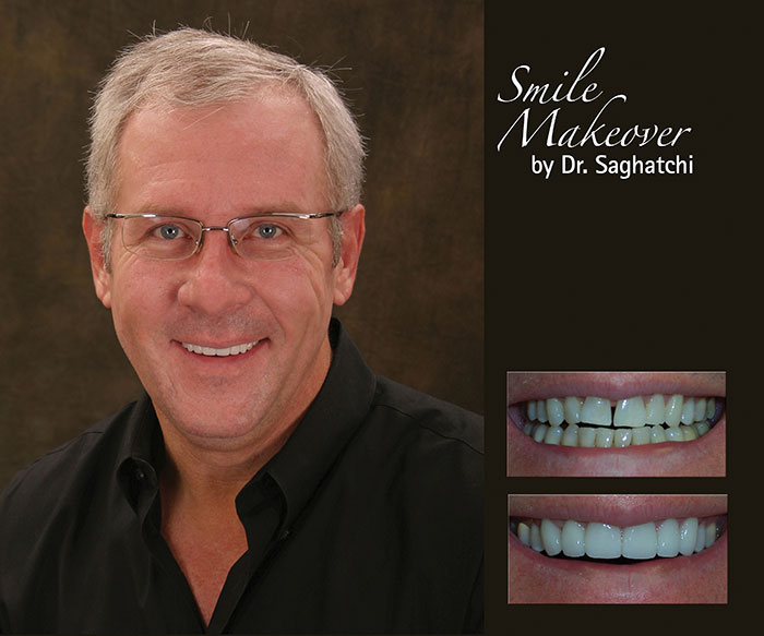 Smile Makeover by Dr. Saghatchi-11